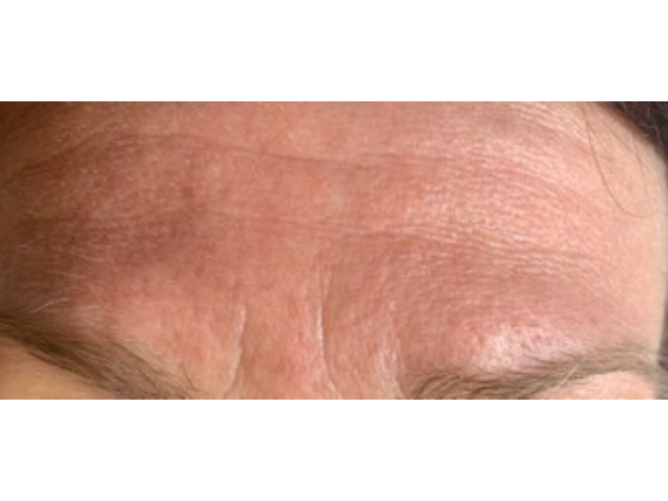 Dry skin (1)