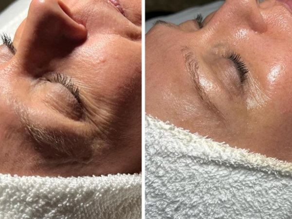 Facial for dry skin